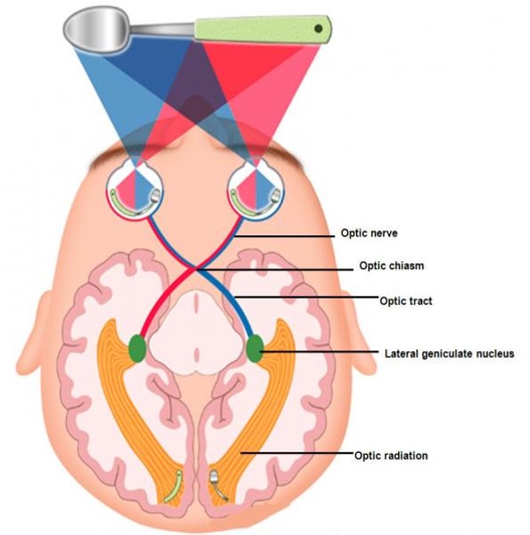 Diagram of the from above of the eyes and brain, identifying optic nerve, optic chiasm, optic tract, lateral geniculate nucleus and optic radiation